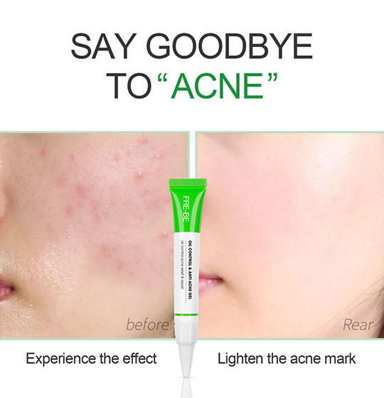 Anti Acne Gel